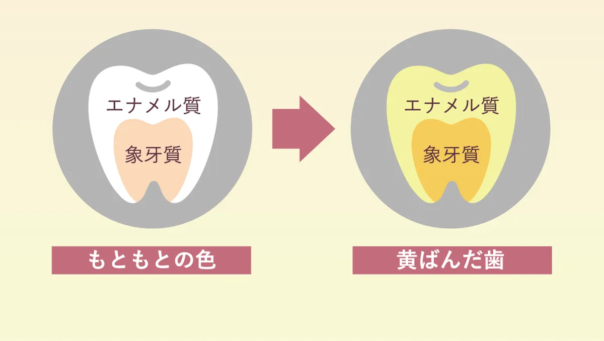 歯の色がきばんでいく理由 着色の変化図